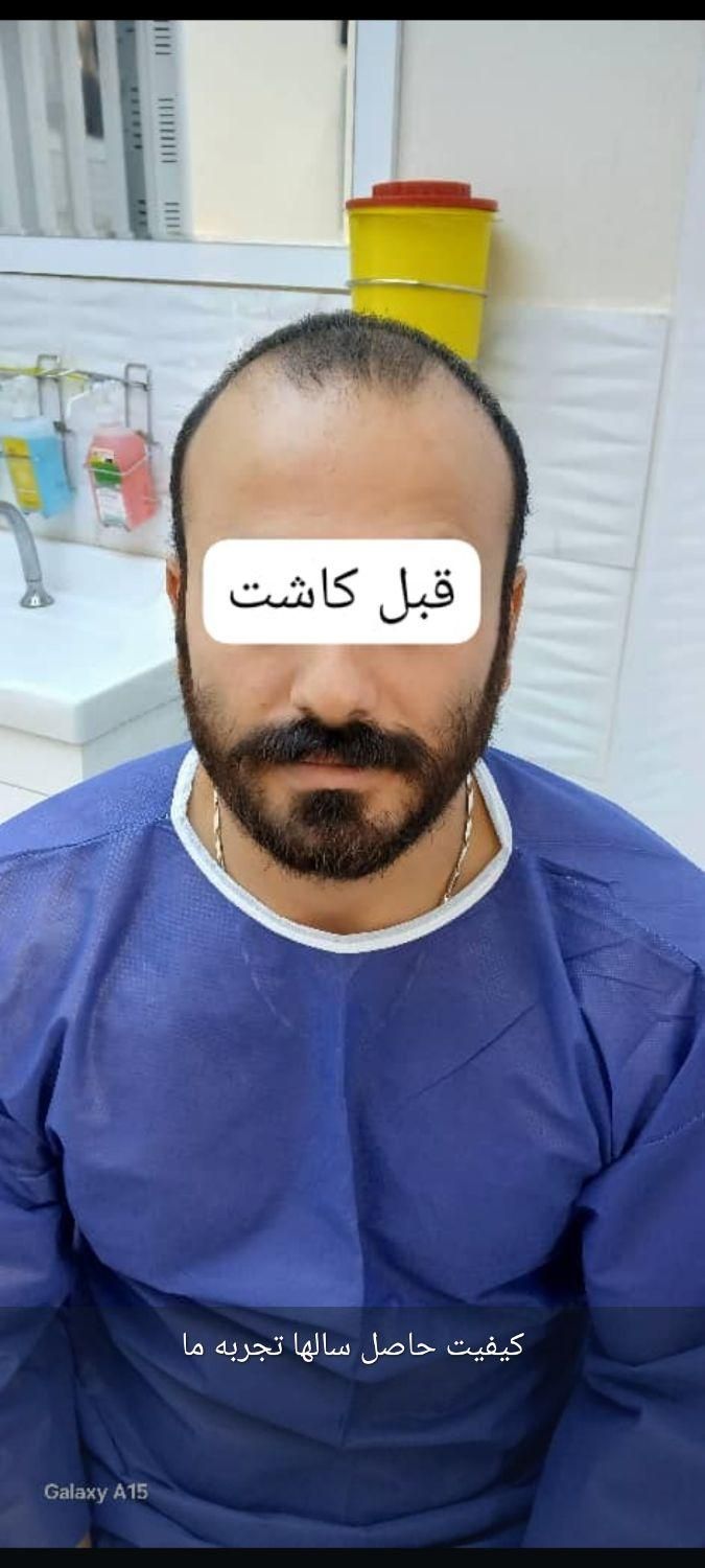 کاشت مو و ابروی طبیعی در اصفهان