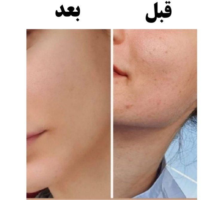 فیشیال ‌ و پاکسازی پوست فقط ۱۰ نفر