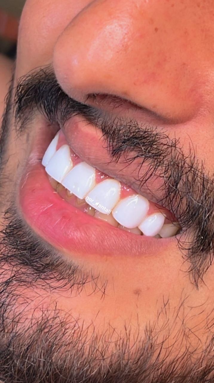 کامپوزیت دندان (با بهترین مواد)