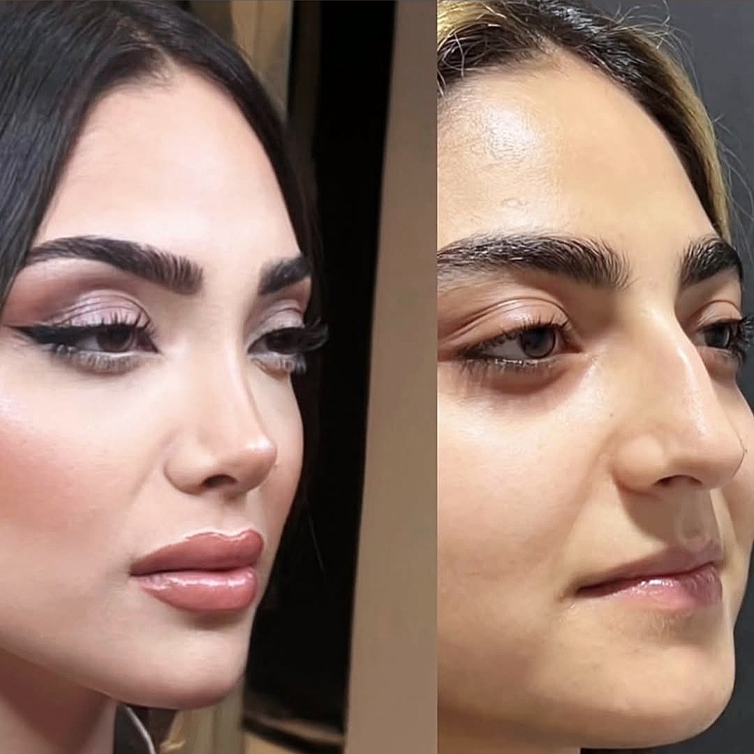 تغییر بینی نیمه گوشتی بعد از یک ماه از عمل
