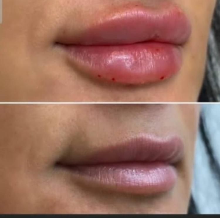 جشنواره نوروزژل وبوتاکس هایفو تراپی مزوتراپی ‌