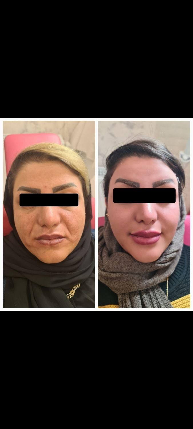 تزریق ژل وفیلر لب و گونه وچانه ومزو(جشنواره)درمطب
