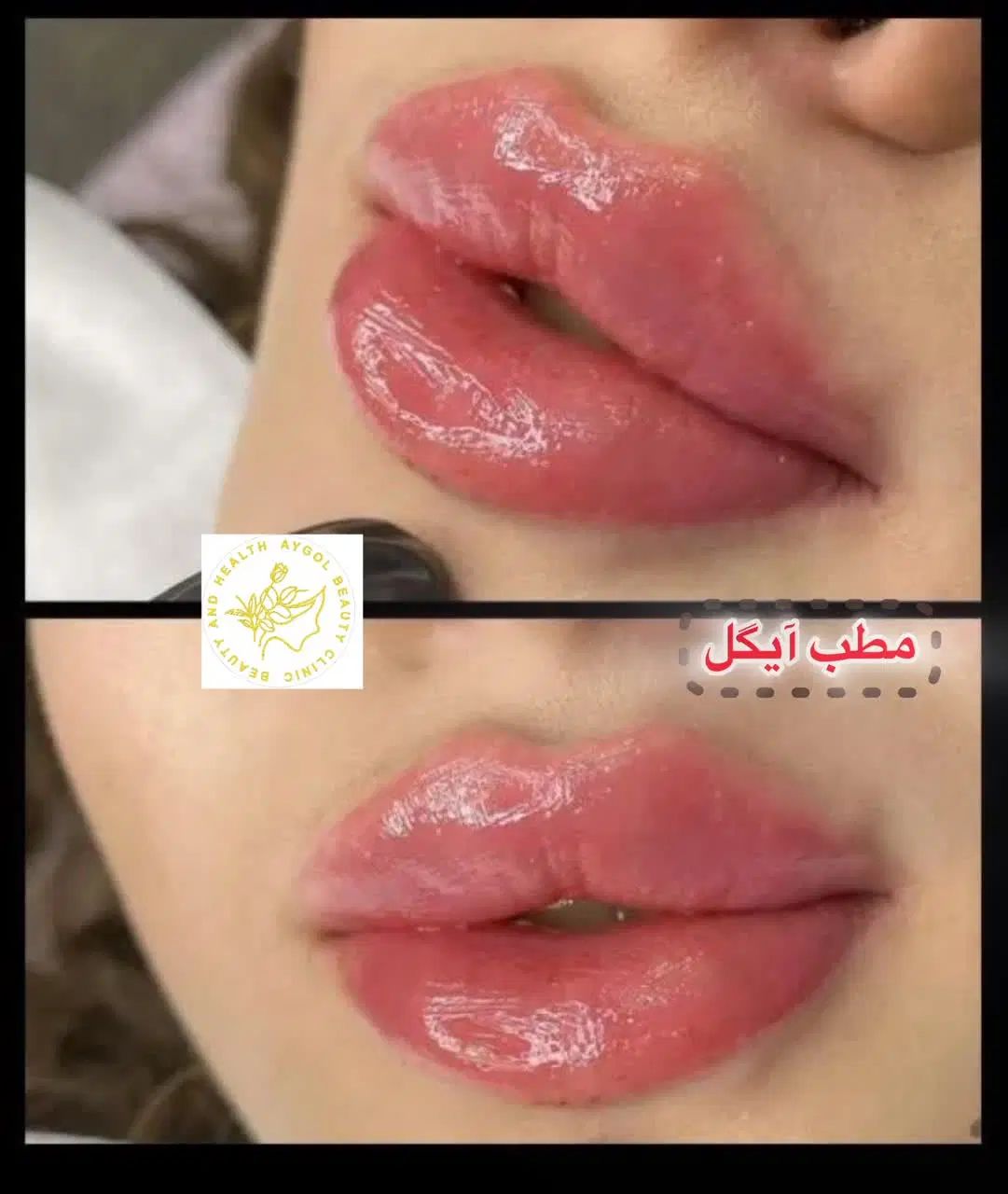 تزریق ژل وفیلر لب و گونه وچانه ومزو(جشنواره)درمطب
