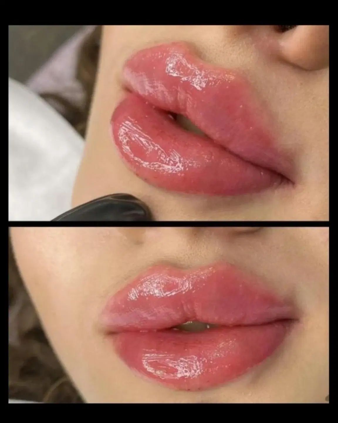 تزریق ژل وفیلر لب و گونه وچانه ومزو(جشنواره)درمطب