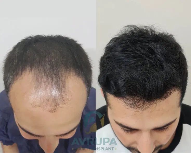 کاشت مو همراه با مزوتراپی رایگان