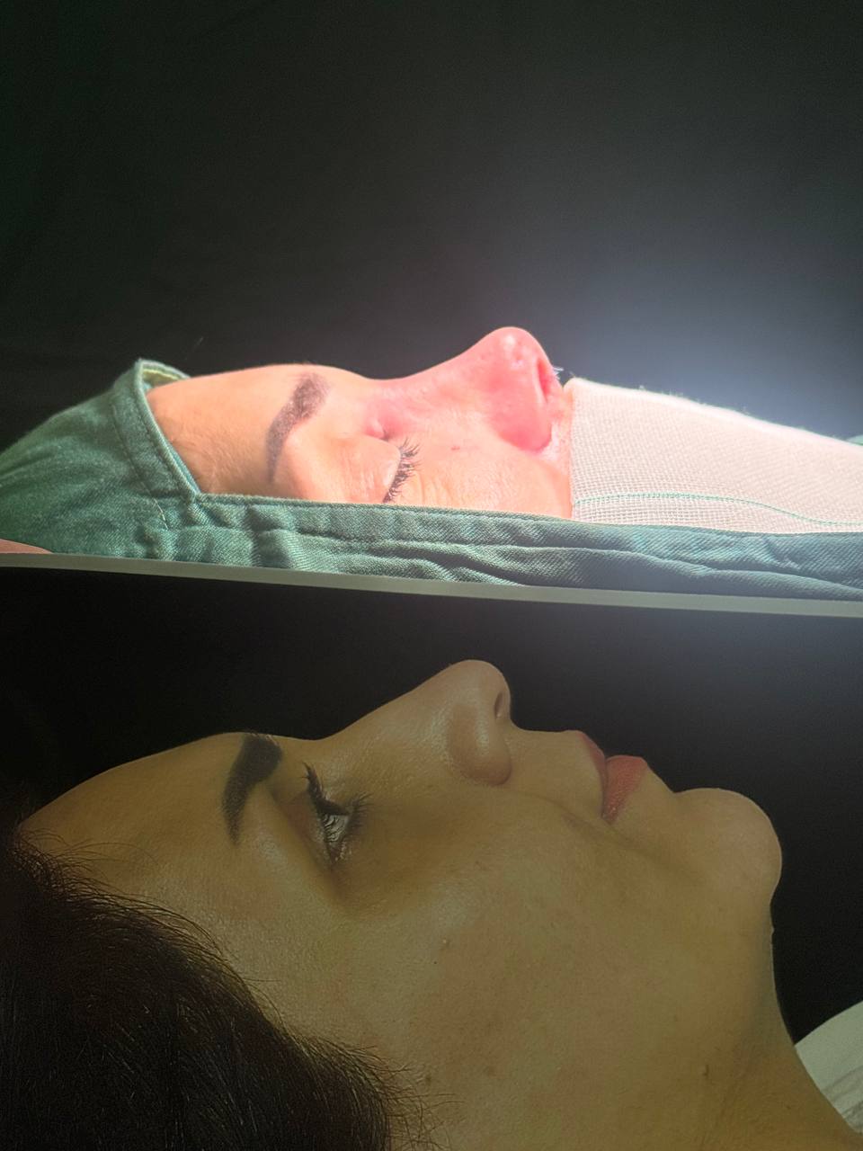 بلفاصله بعد از عمل زیبایی بینی