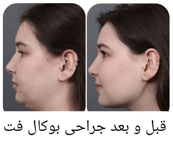 بوکال فت صورت