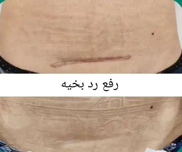 لیزر و رفع رد بخیه و اسکار