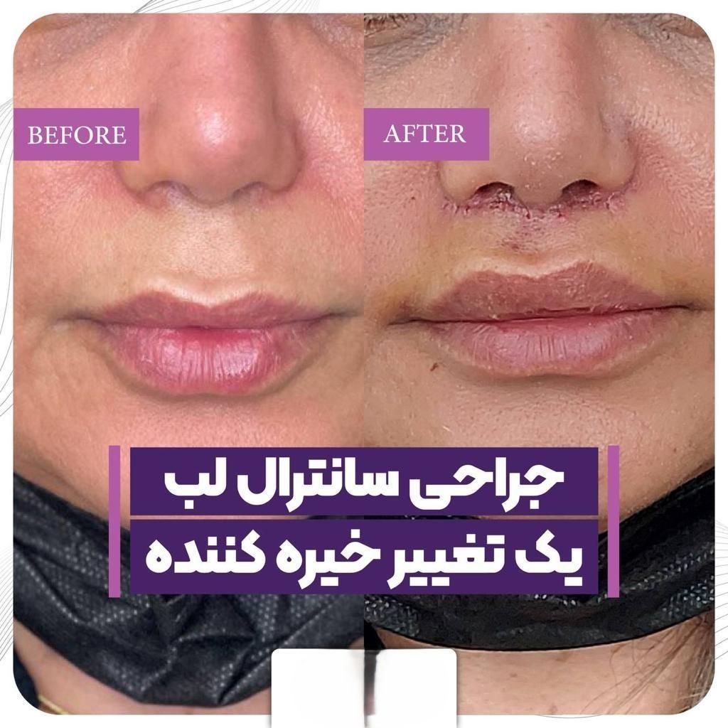 جراحی سانترال لب