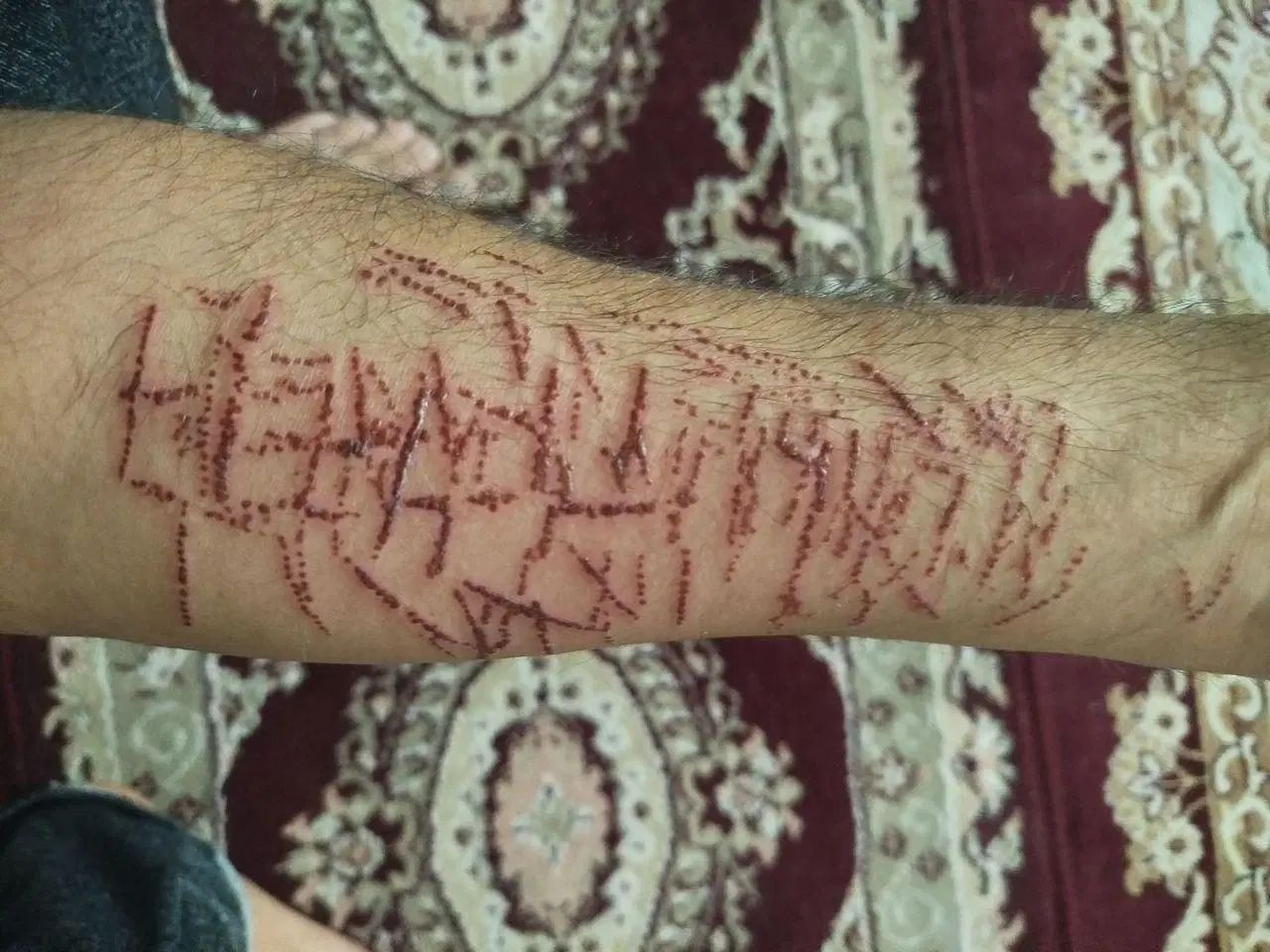 لیزر رد بخیه و اسکار
