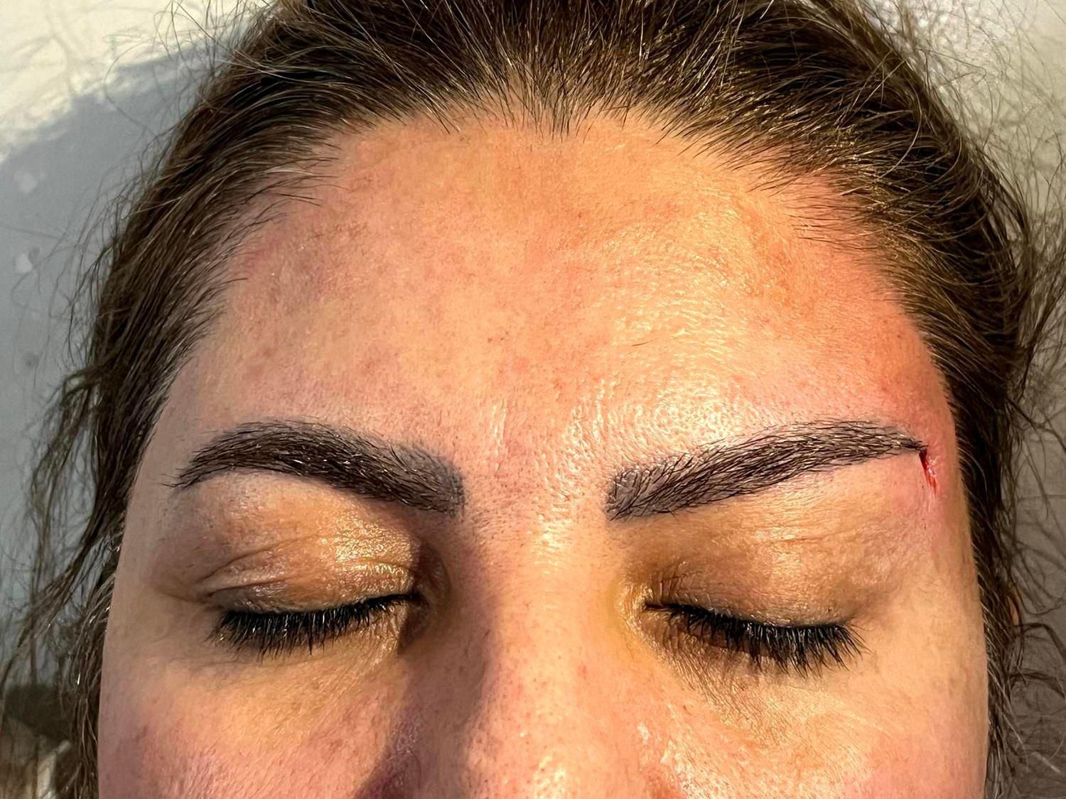 تزریق ژل لیفت صورت لیفت شقیقه ابرو