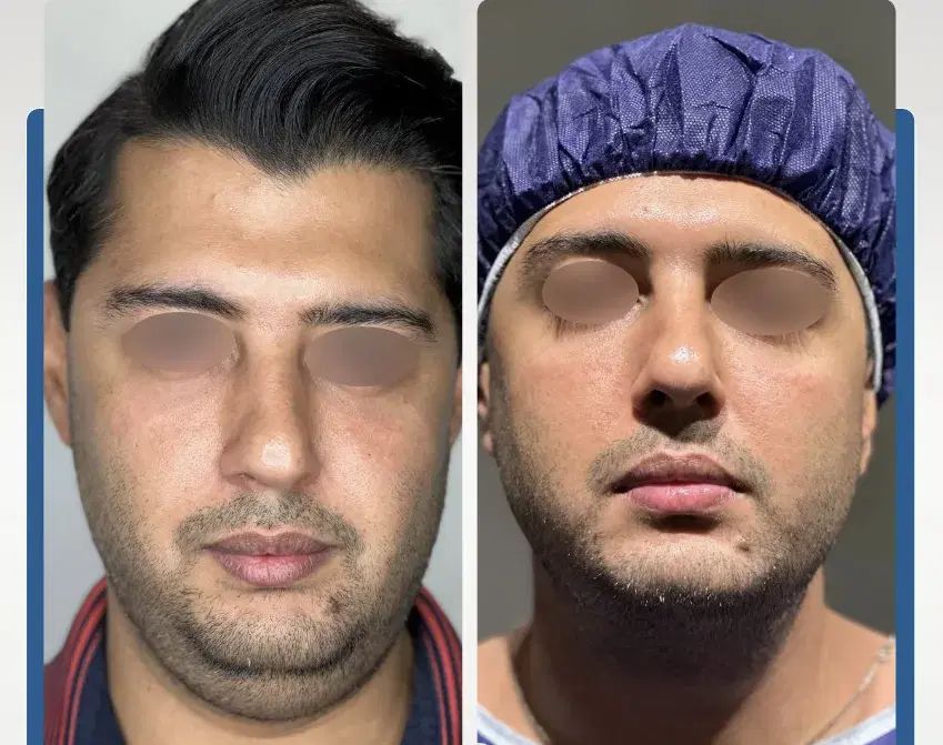 ساکشن غبغب و بوکال فت صورت