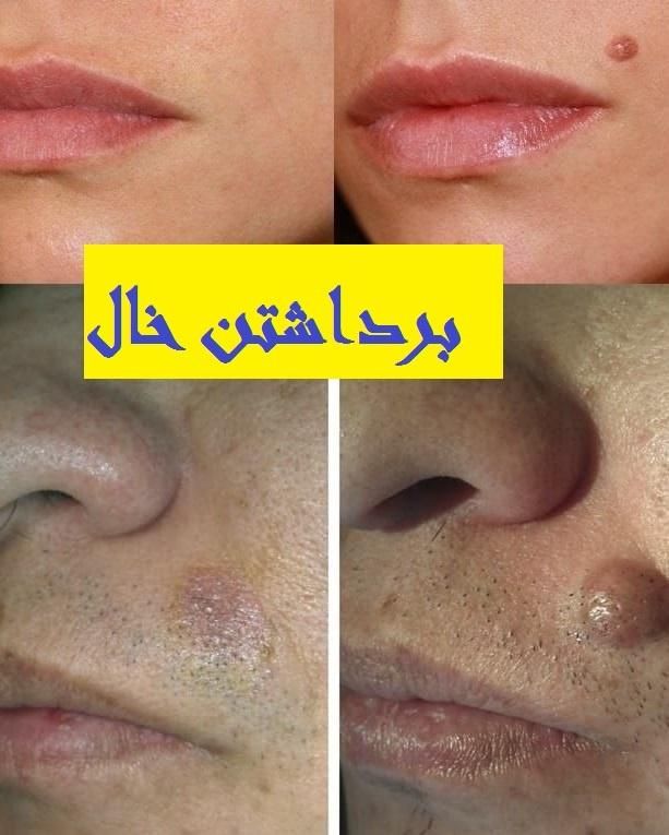 برداشتن خال با لیزر در یک جلسه