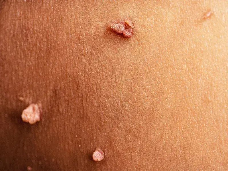رفع و درمان زگیل و hpv