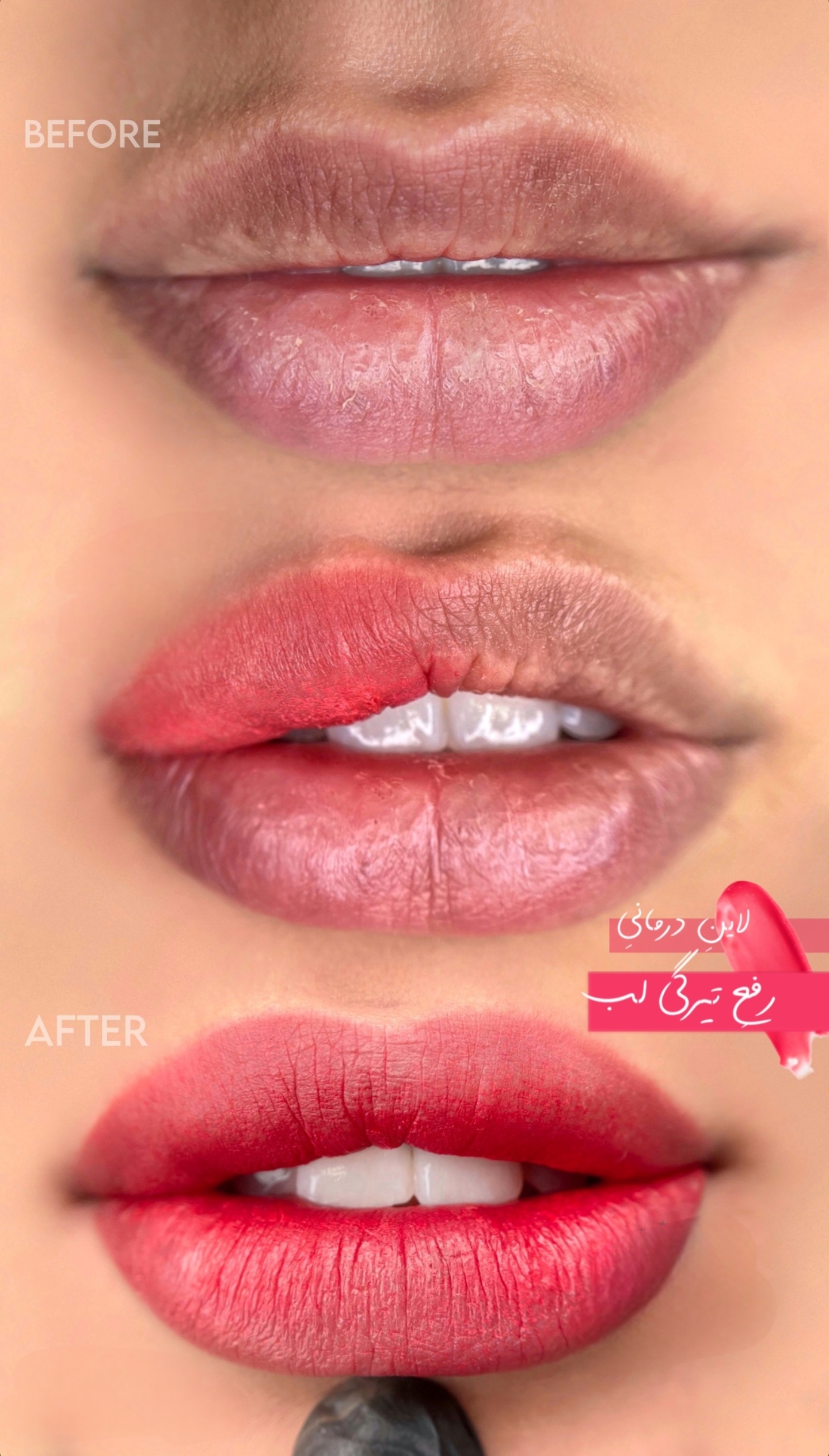 رفع تیرگی و کبودی لب