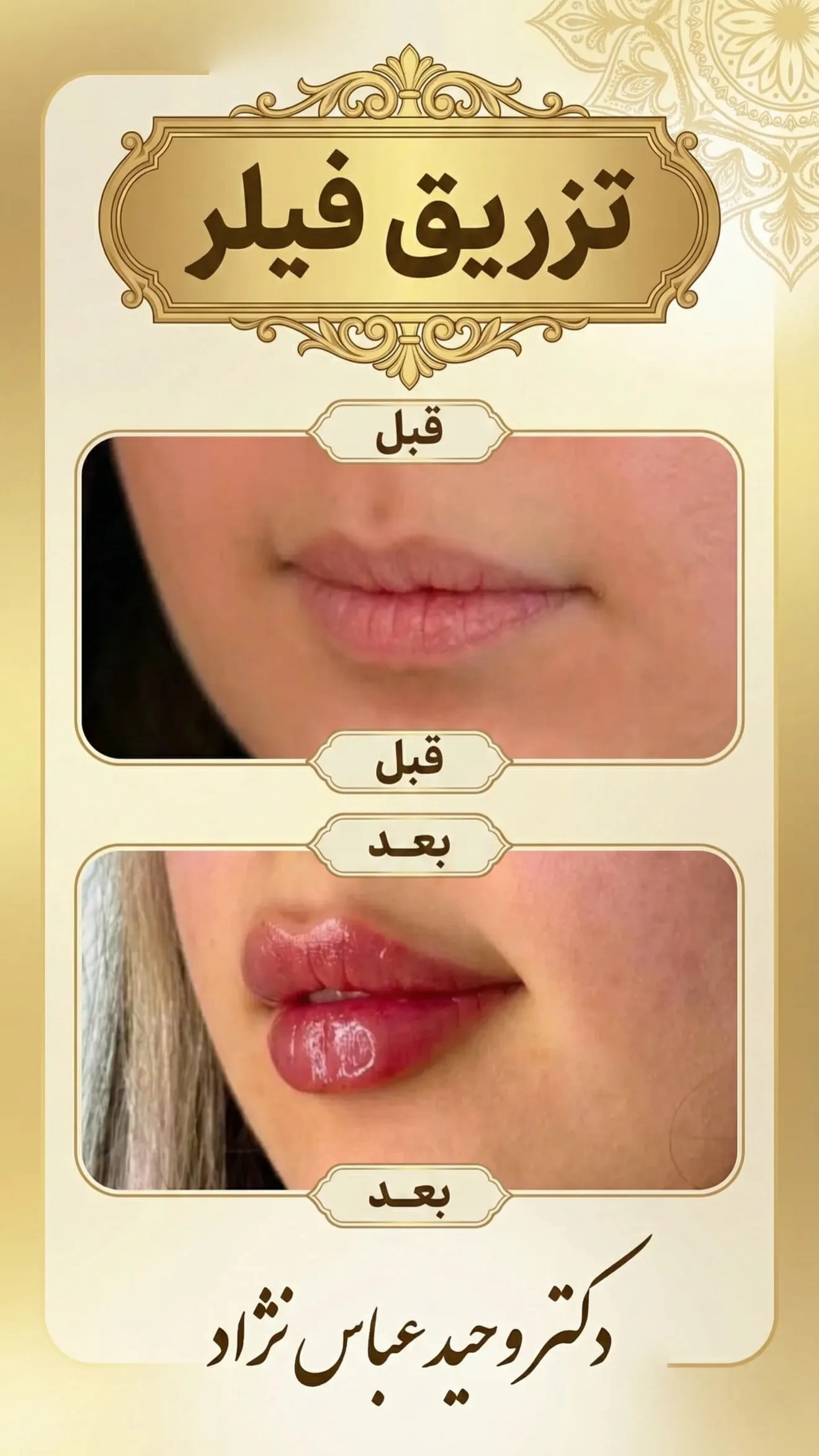 فیلر لب
