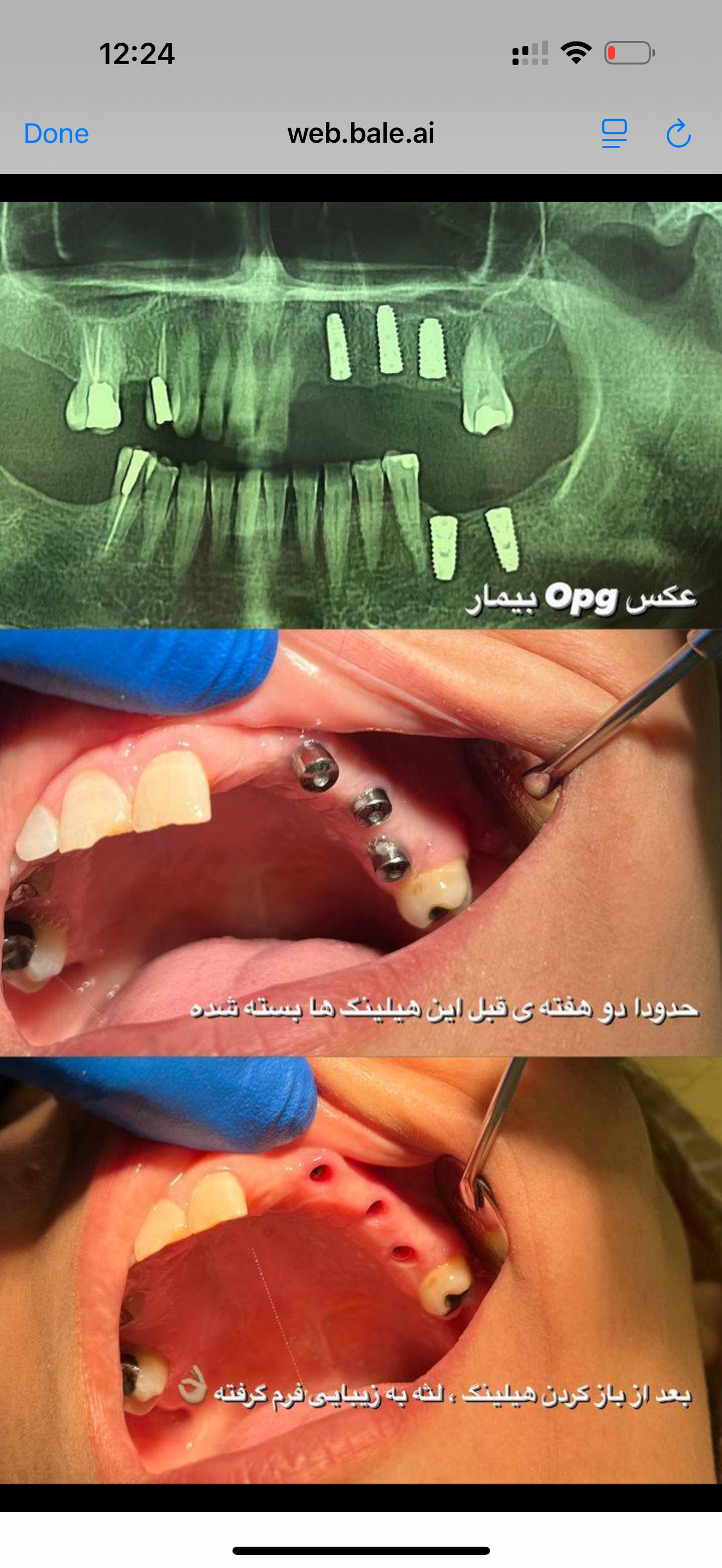 ایمپلنت از دم قسط