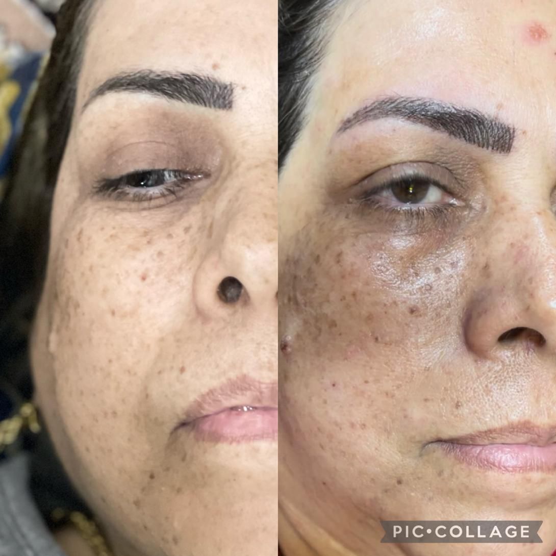 فیشیال و پاکسازی عمقی پوست با تخفیف ویژه