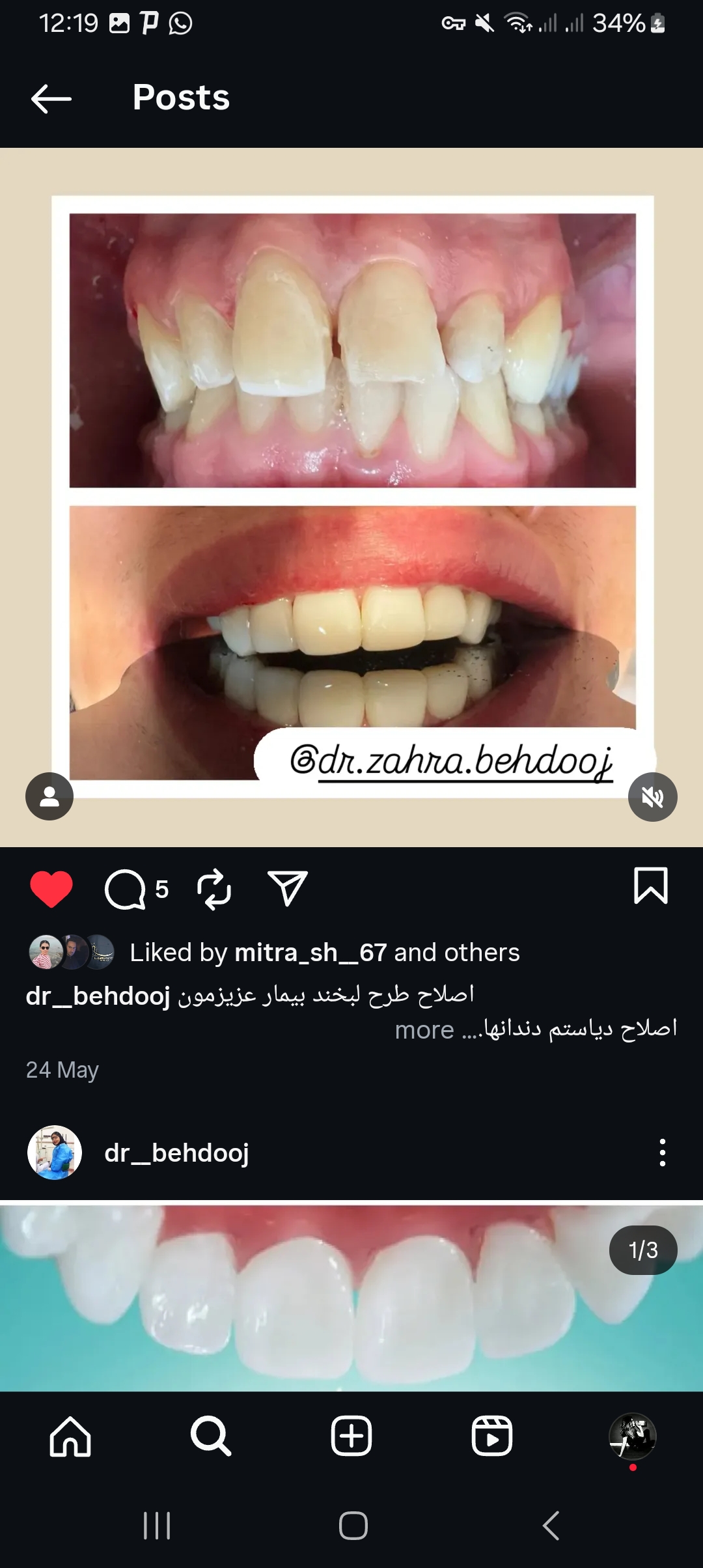 ایمپلنت